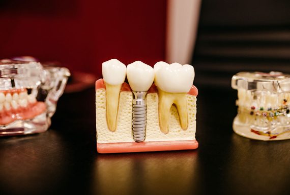 Prothèses sur Implants